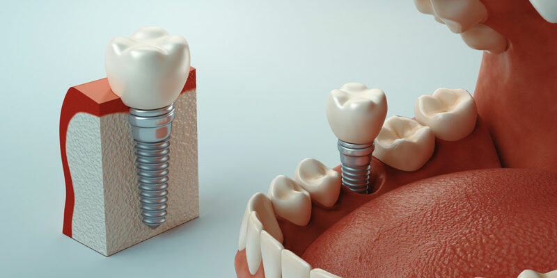 implantate